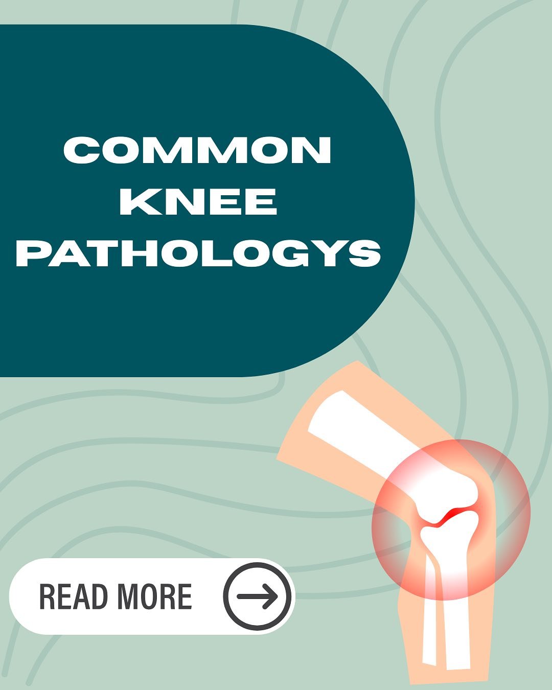 🦵Dealing with Knee Pain?🦵
Knee pain can be a real hurdle, but understanding the cause is the first step to finding relief! If you’re experiencing discomfort in your knee, it could be one of these common conditions we see in our clinic:
💥 A