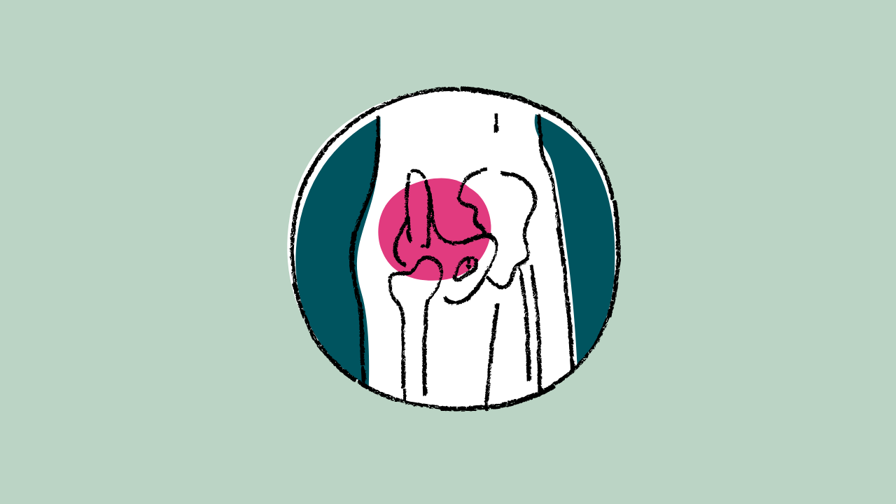 Hip Pain: It’s Not Always the Hip