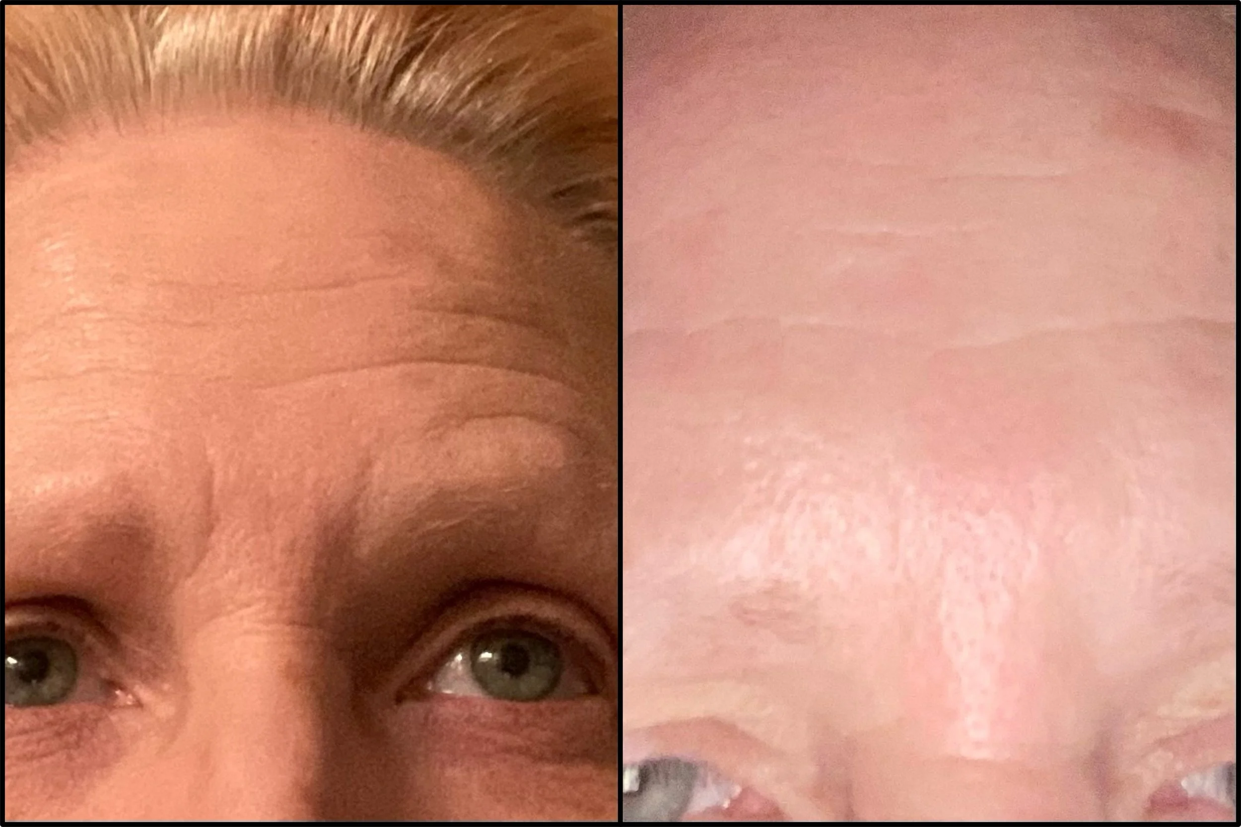 Close-up of a person's forehead showing wrinkles and skin texture, with another close-up of the forehead skin texture.