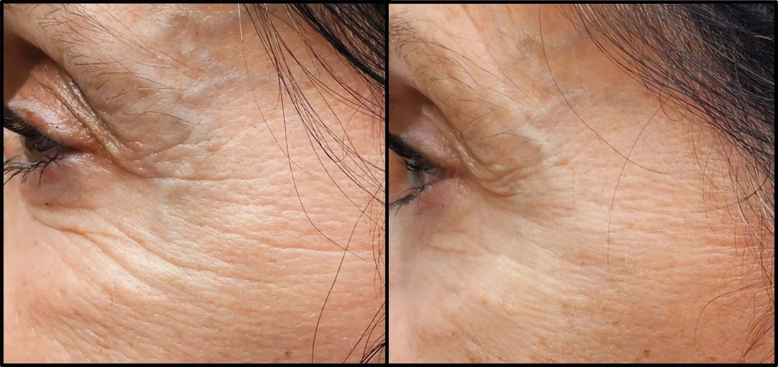 Close-up comparison of facial skin with visible wrinkles and fine lines, showing reduction on the right side.