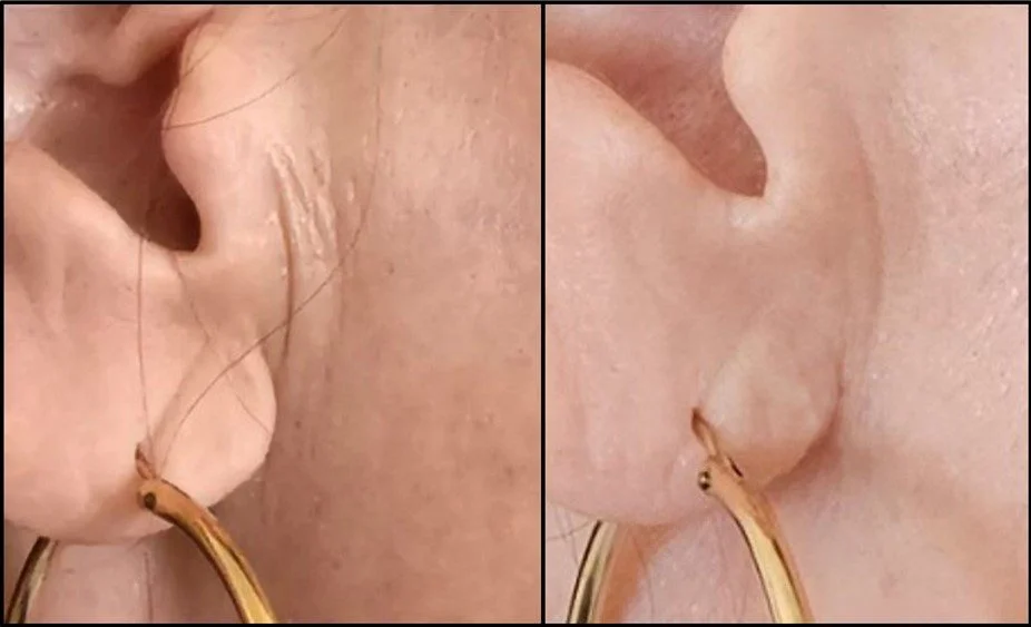 Close-up of a person's ears with gold hoop earrings, one showing a pierced hole and the other displaying the earring on the earlobe.
