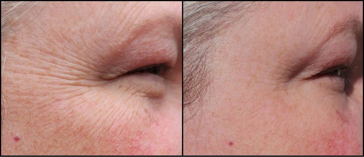 Close-up comparison of eye area showing reduction of wrinkles and fine lines on the left before and on the right after skincare treatment.