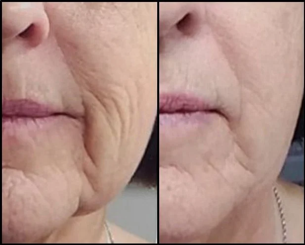 Close-up of a woman's face showing a comparison of skin texture, with noticeable reduction in wrinkles on the right side.