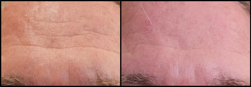 Comparison of a forehead with dry, wrinkled skin on the left and smoother, more hydrated skin on the right.