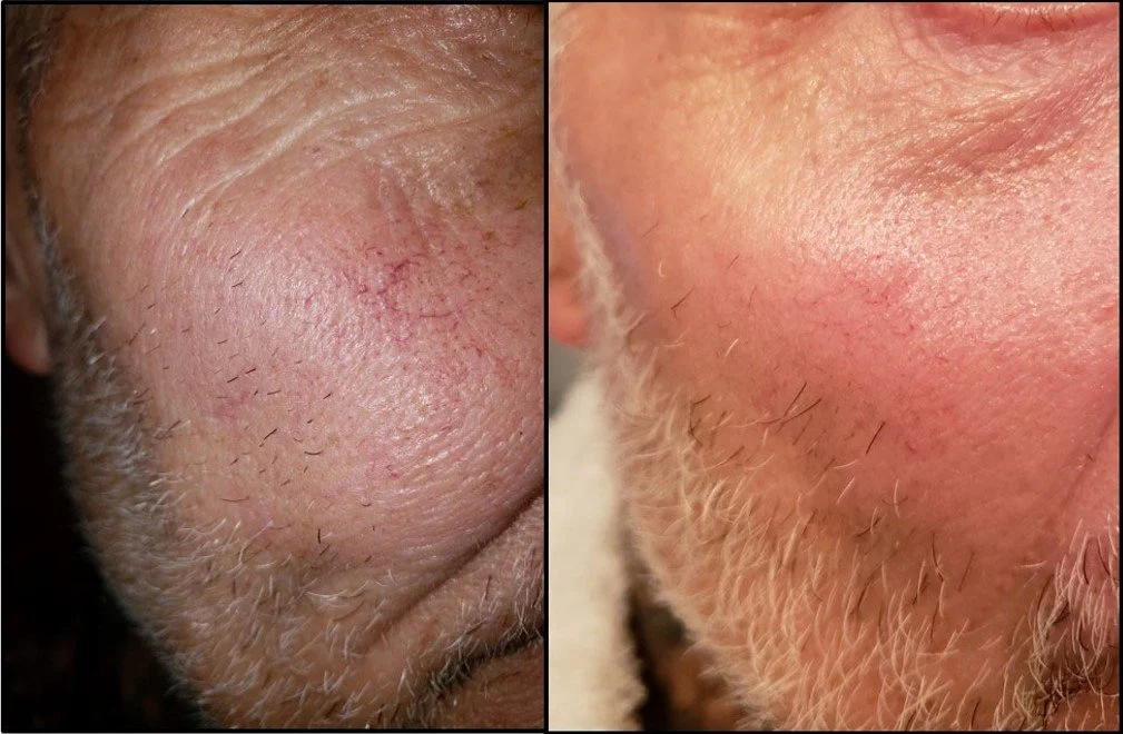 Close-up of a person's cheek and chin showing before and after skin improvement.