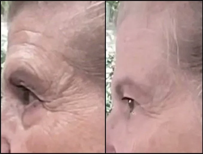 Side-by-side comparison of a woman's face, showing reduced wrinkles around her eye in the after photo.