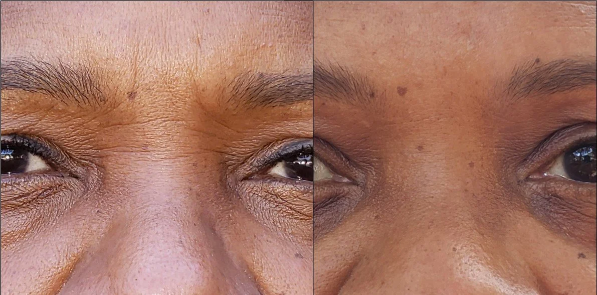 Close-up of a person's eyes with a before-and-after comparison showing skin improvements around the eyes.