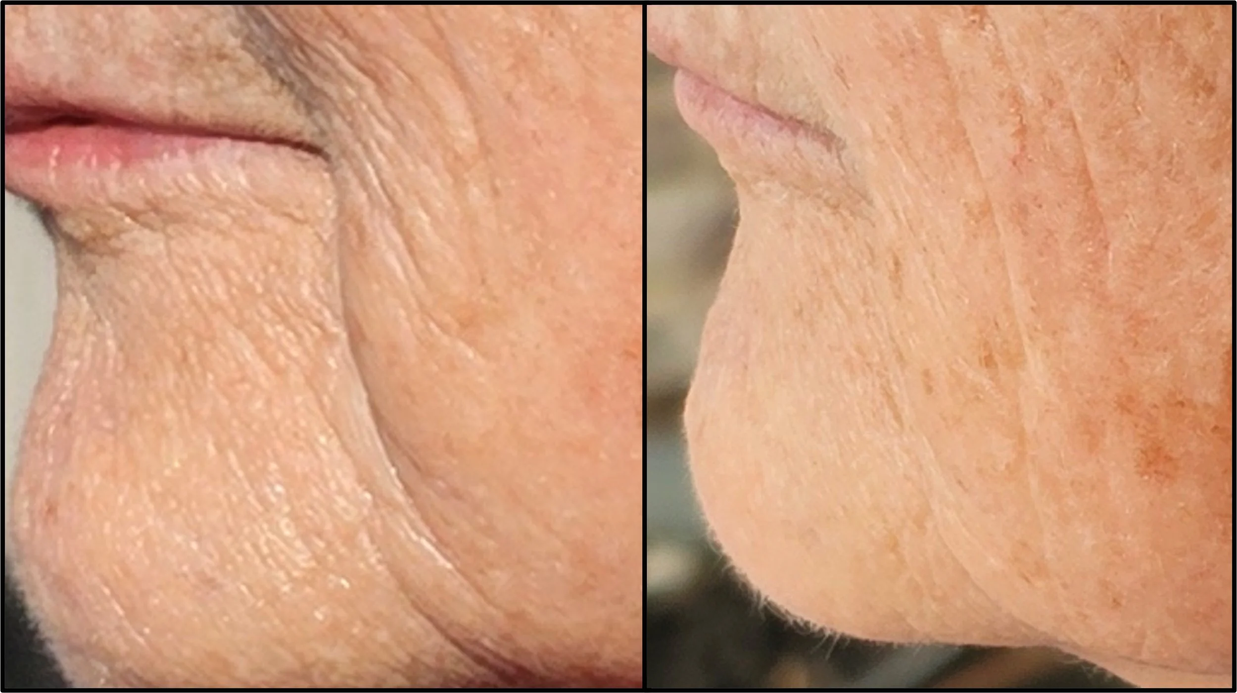 Close-up comparison of an elderly person's face, showing changes in skin texture and appearance from the cheek and mouth area on the left to the nose and side of the face on the right.