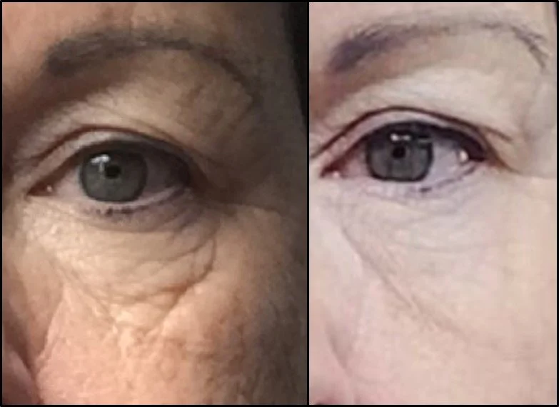 Close-up comparison of an older person's eye area showing less wrinkles on the right side after cosmetic treatment or skincare.