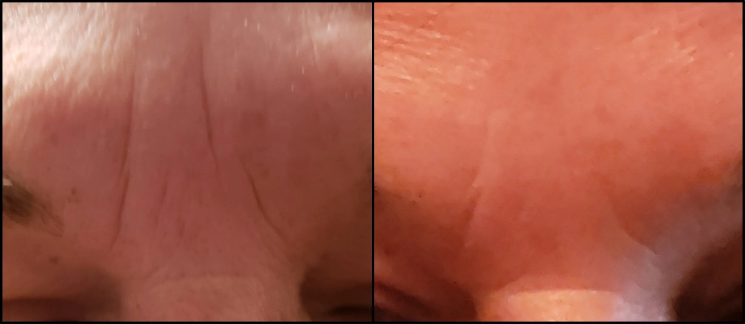 Close-up images showing the skin of a person's nose from two different angles.