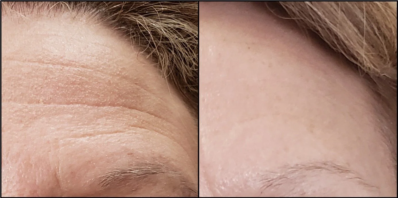 Comparison of a person's forehead showing wrinkles in the left image and smooth skin in the right image.