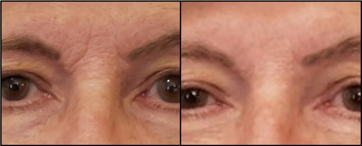 A side-by-side comparison of a person's eye area before and after skincare treatment, showing reduced wrinkles and improved skin texture.