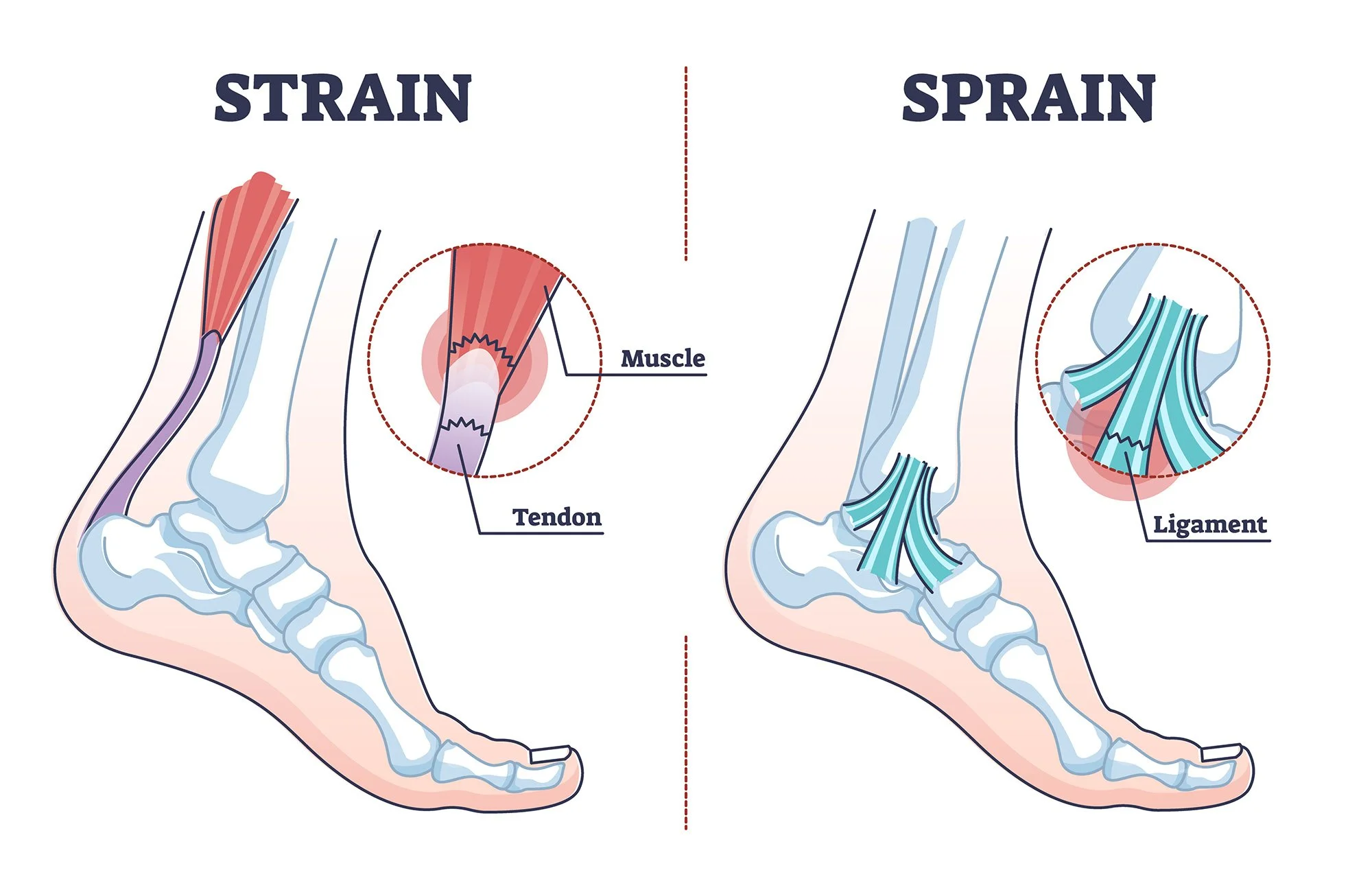 Sprains & Strains