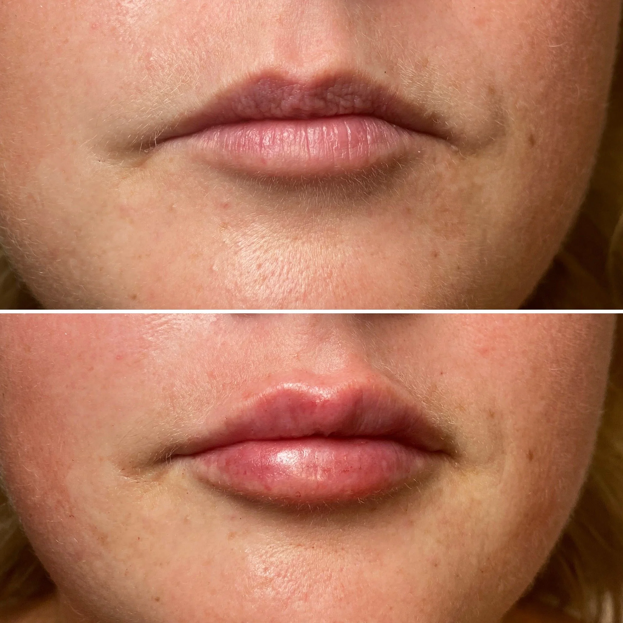 Lip Fillers Winter Haven