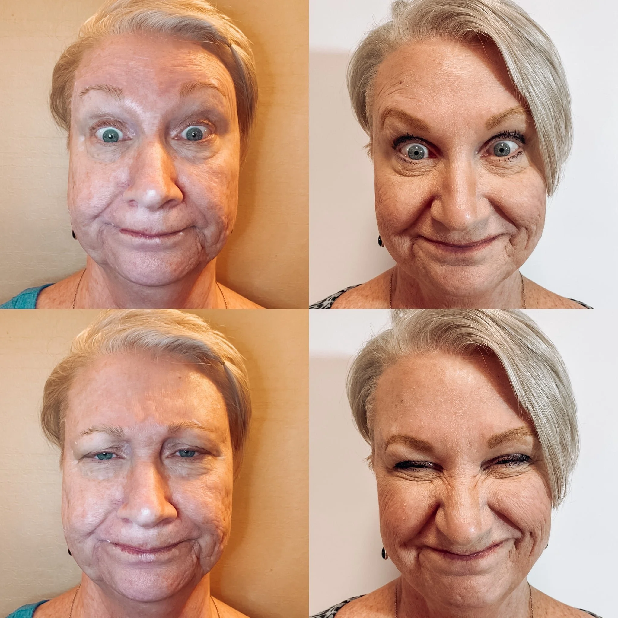 Botox Winter Haven FL