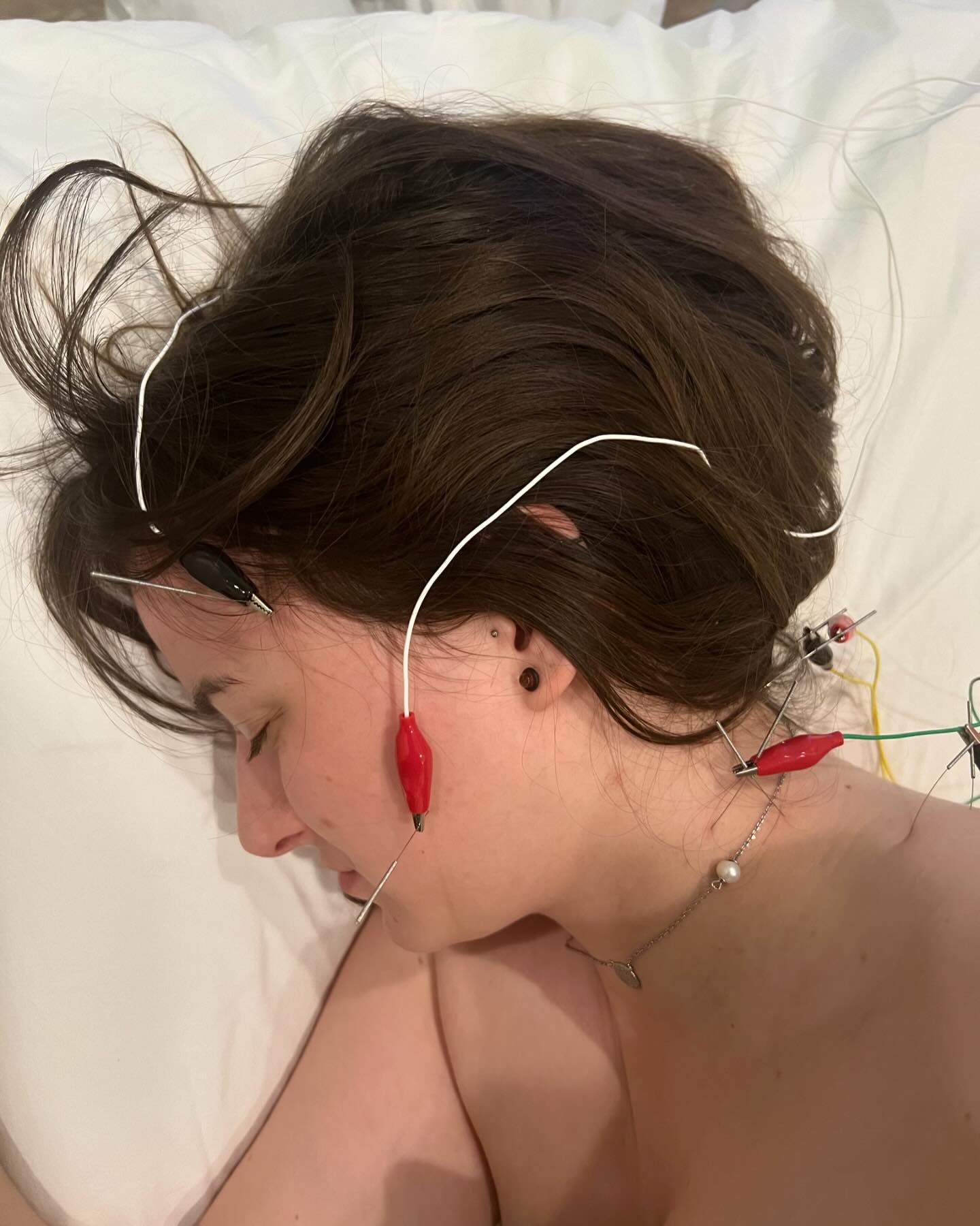 TMJ/jaw pain is well addressed with acupuncture treatment.

Did you know that in the majority of cases with TMJ/jaw pain the dysfunction stems from muscular imbalances? Unless you have a congenital abnormality in the TMJ from birth or you have suffer
