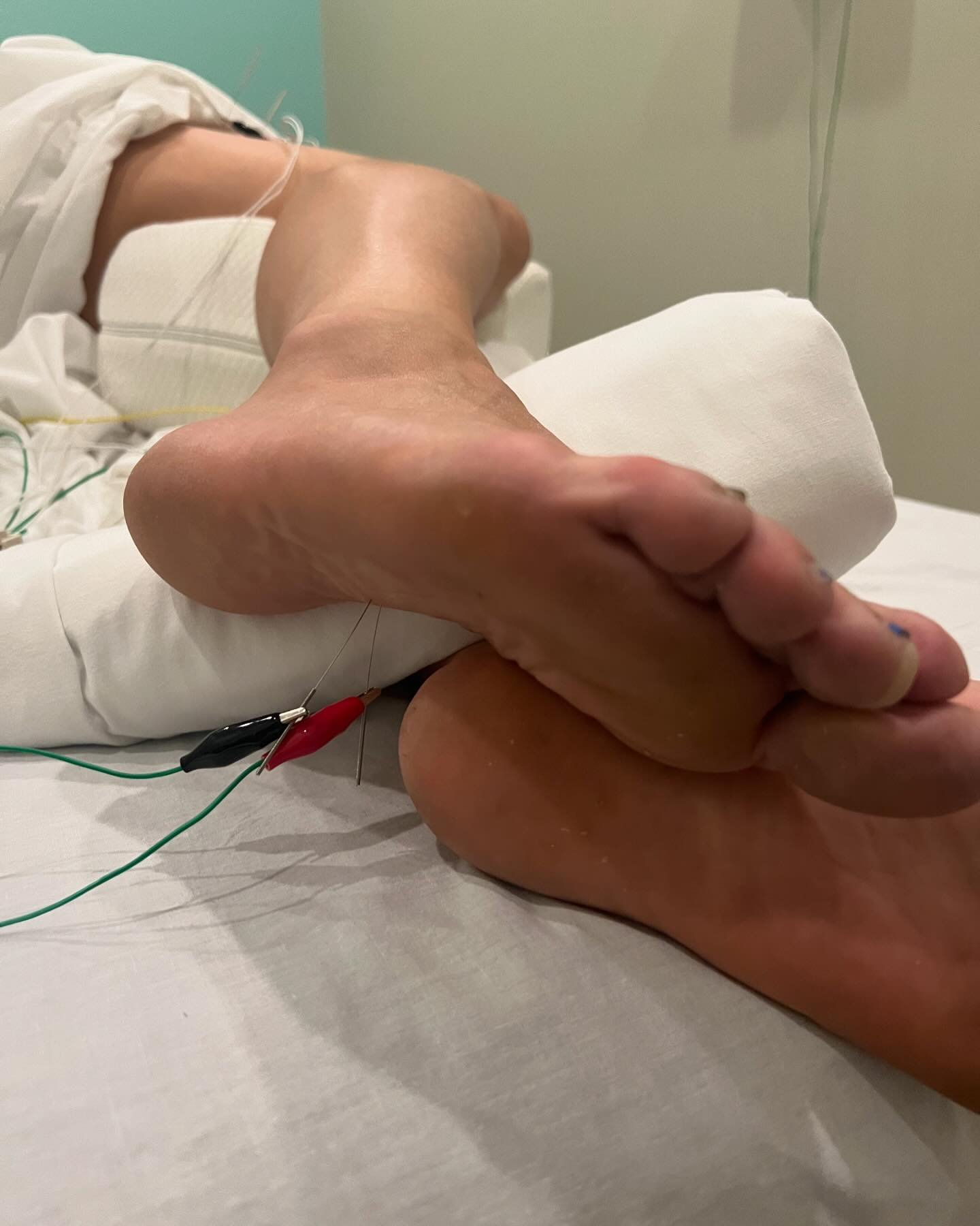 This patient developed pain in the plantar aspect of their foot from repetitive strain of the flexor digitorum brevis of their foot after an ultra-marathon.

The flexor digitorum brevis muscle in the foot primarily performs the action of flexing the 