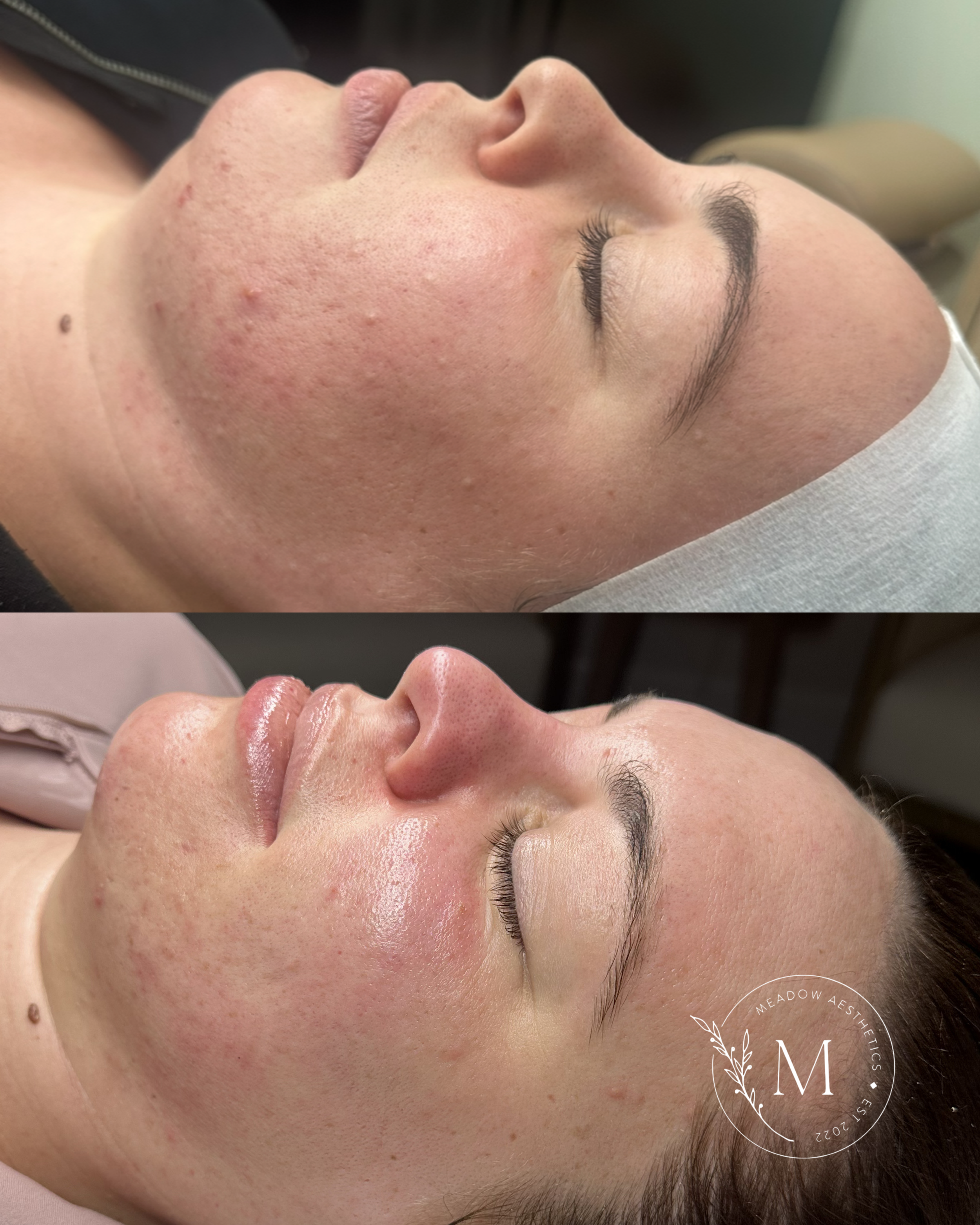 Custom skin plan before and after to promote skin rejuvenation services at Meadow Med Spa + Aesthetics in Wichita, KS.