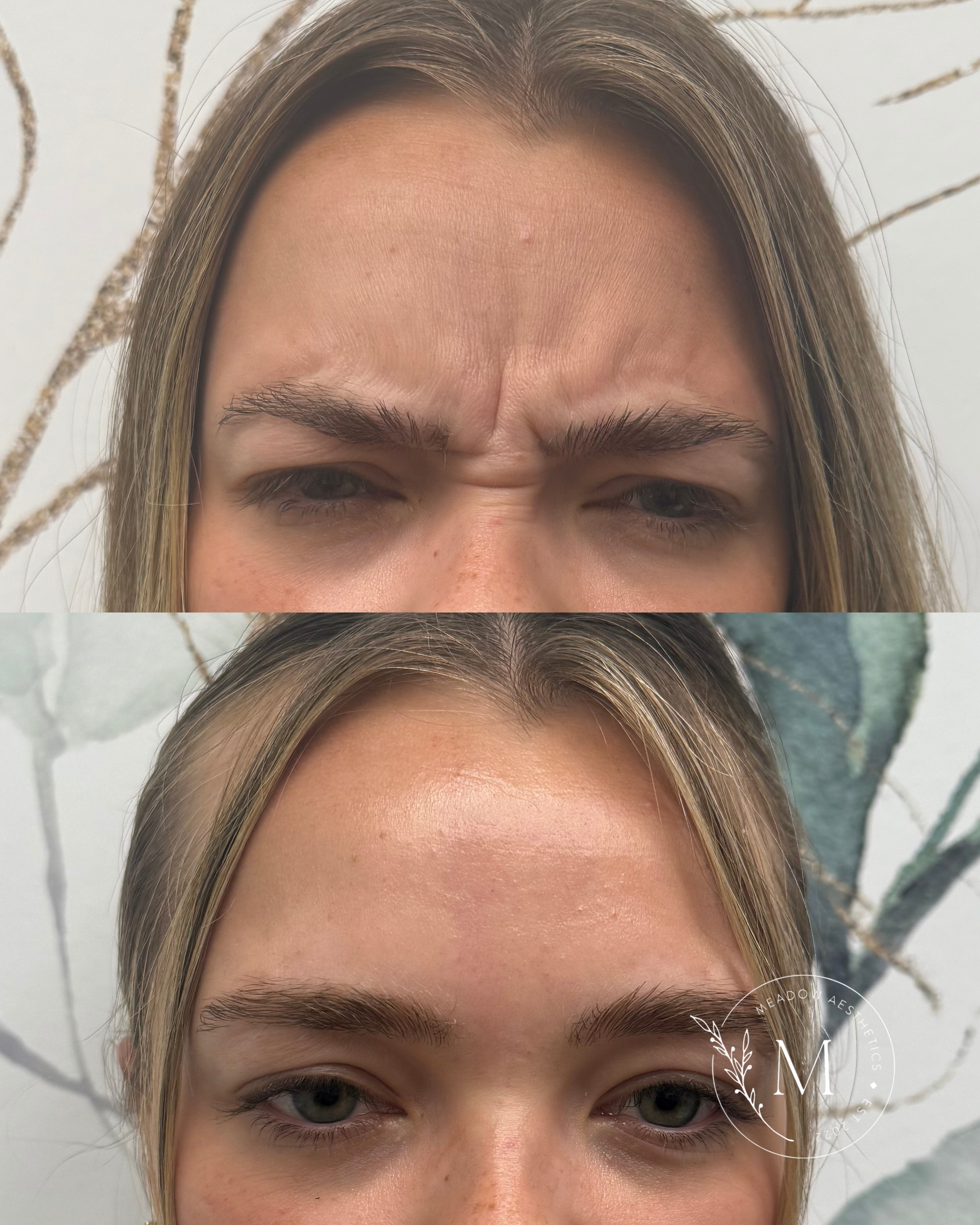 Daxxify before and after to promote wrinkle relaxer services at Meadow Med Spa + Aesthetics in Wichita, KS.