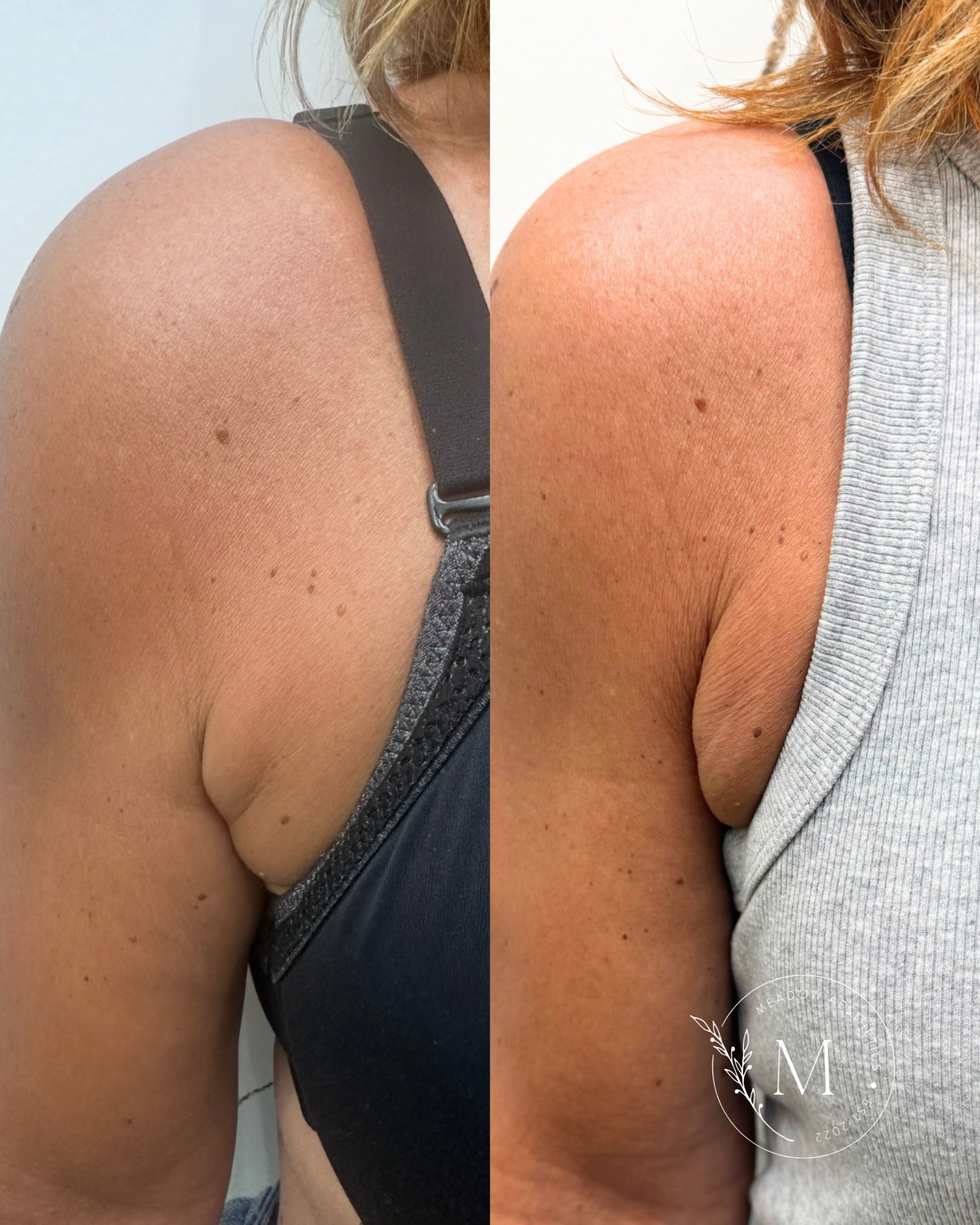 PCDC before and after to promote fat dissolving injection services at Meadow Med Spa + Aesthetics in Wichita, KS.