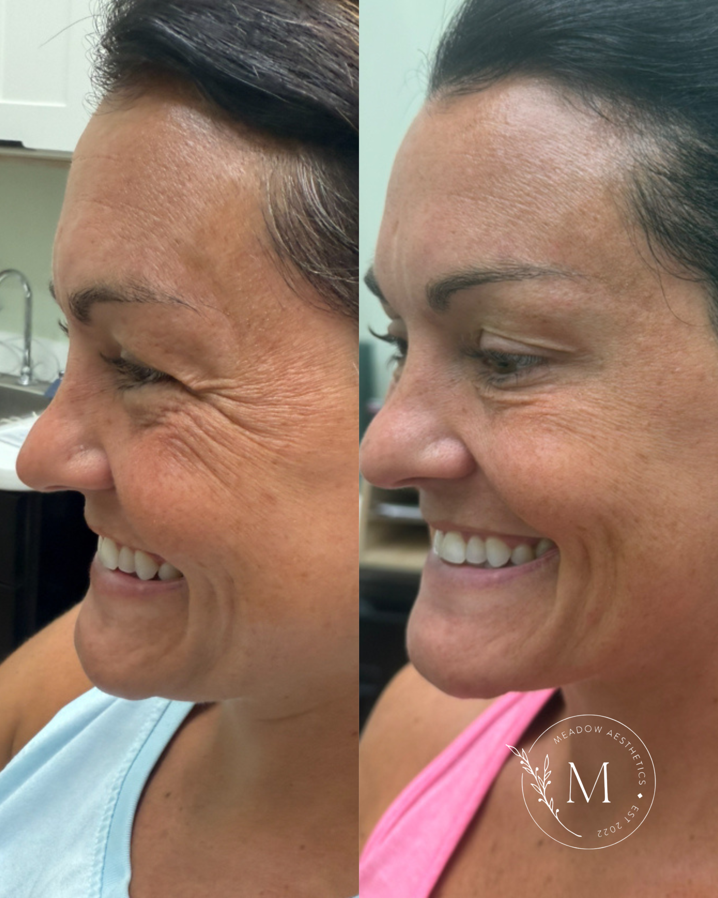 Botox before and after to promote wrinkle relaxer services at Meadow Med Spa + Aesthetics in Wichita, KS.