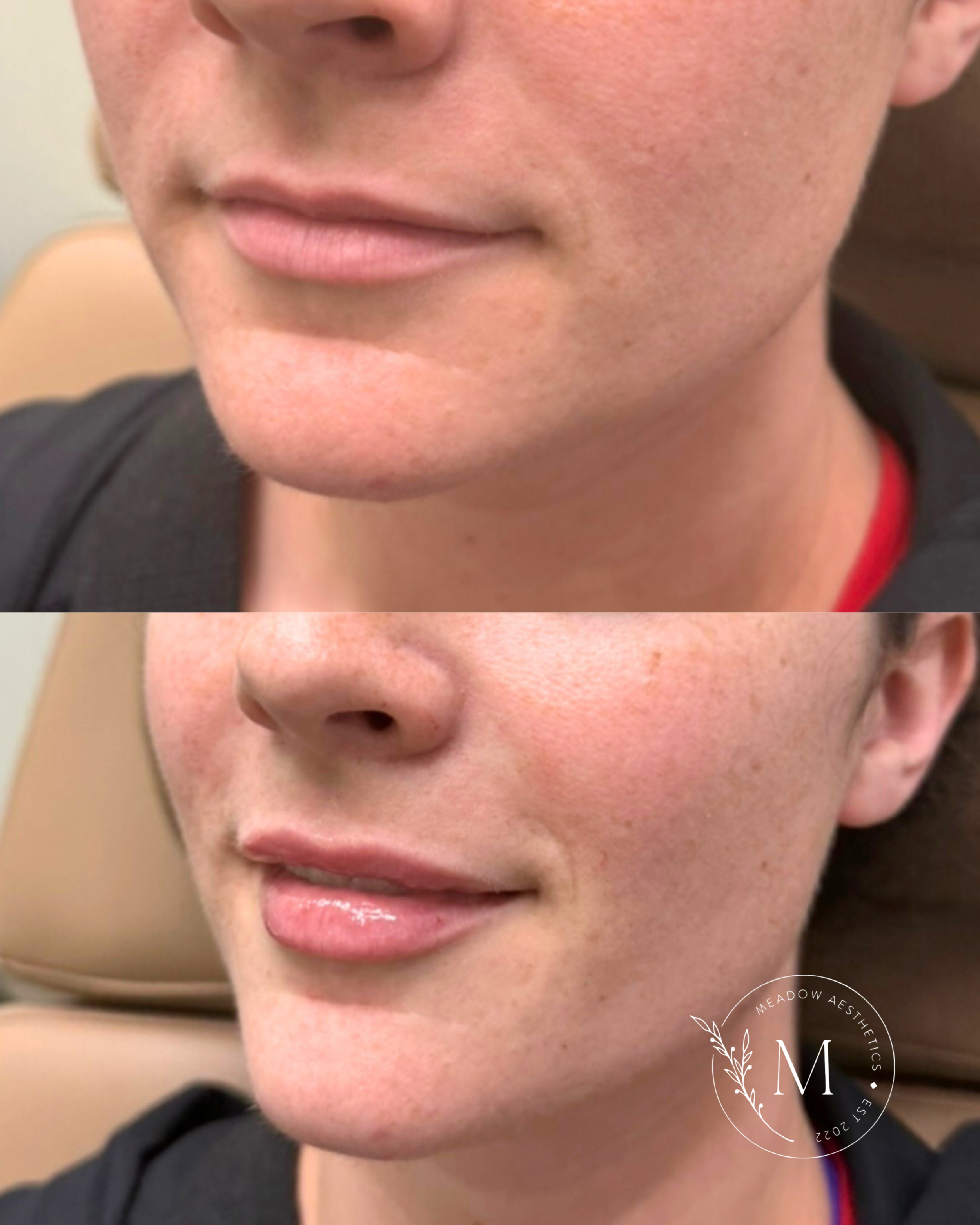 Lip filler before and after to promote dermal filler services at Meadow Med Spa + Aesthetics in Wichita, KS.