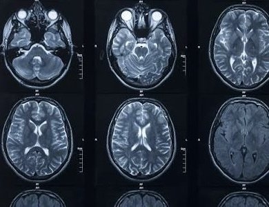 MRI Brain Scan