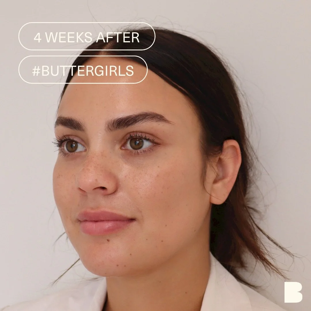 Lip Filler Hobart | Butter Cosmetic and Skin Clinic Hobart | Lip Injections | Lip Filler Before and After
