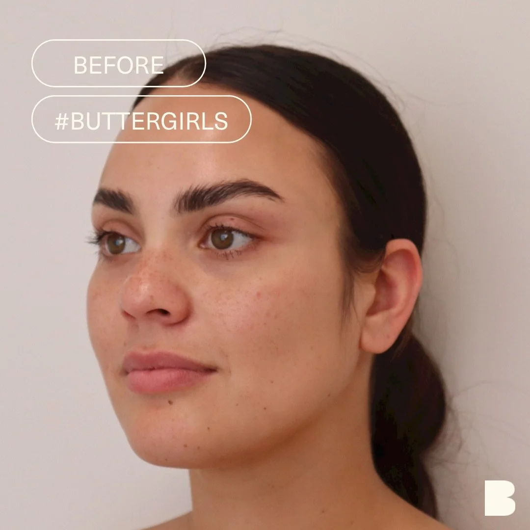 Butter Cosmetic + Skin Clinic | Lip Filler Before and After