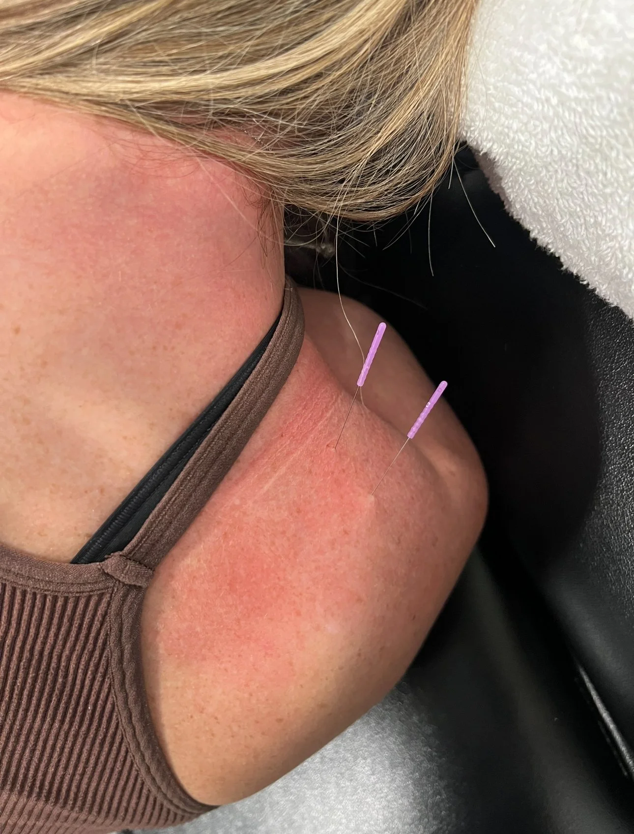Understanding Dry Needling for Rotator Cuff Injuries at OC Well Studio in Newport Beach, CA