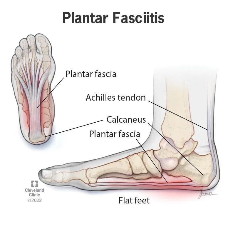plantar fasciitis.jpg