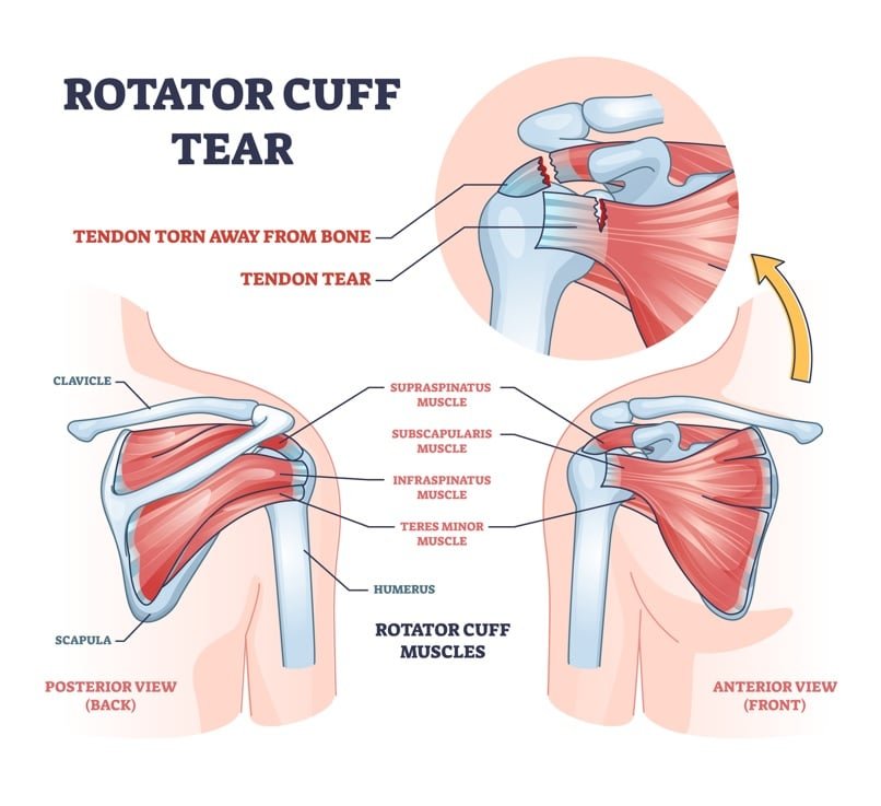 illustration-of-rotator-cuff-tear.jpg
