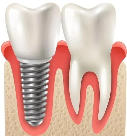 Dental Implants 