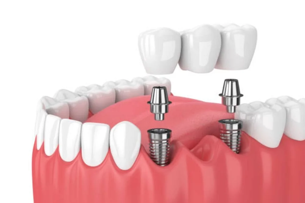 Closing the Gap: Everything You Need to Know About Dental Bridges