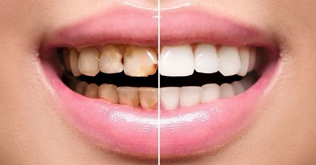 Porcelain Veneers in Toronto: The High-End Smile Makeover That Lasts