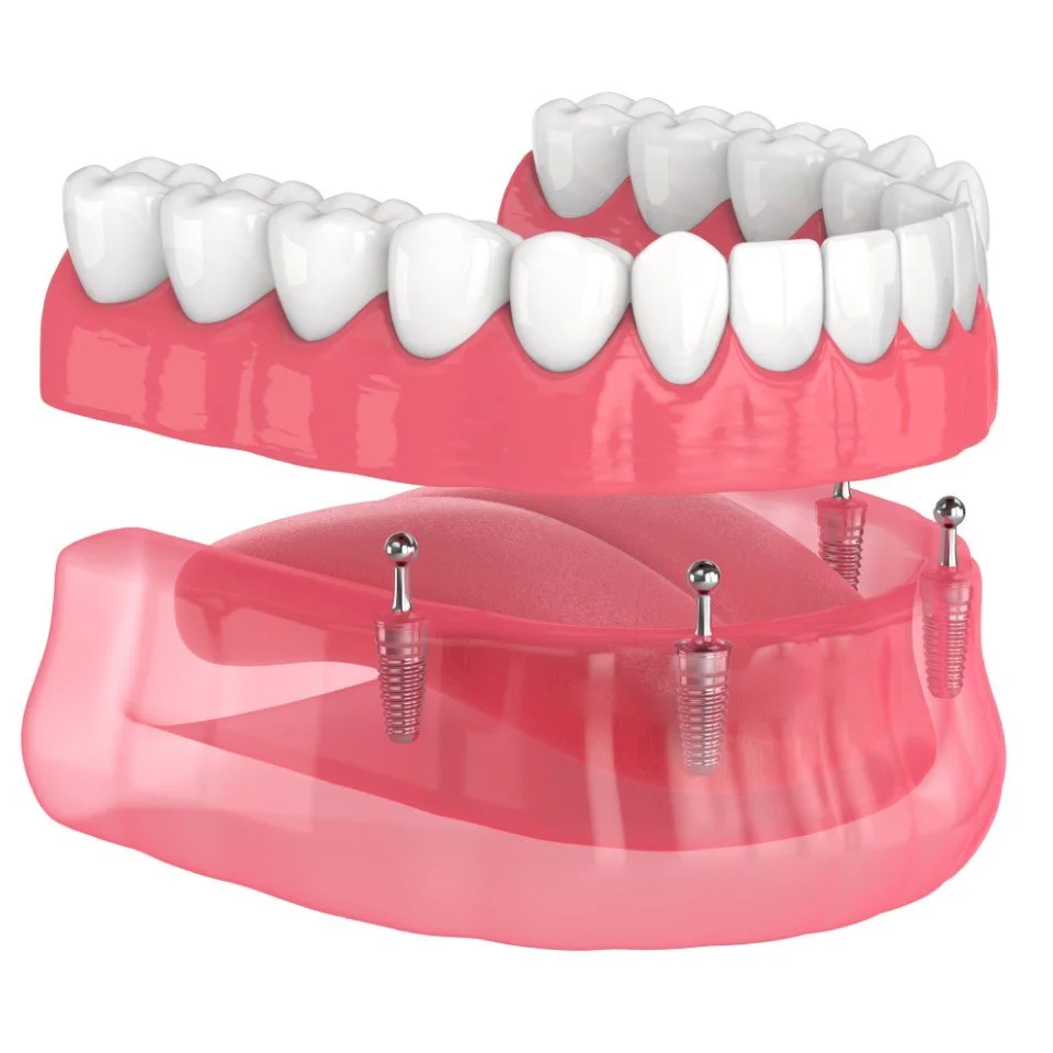 Ultimate Guide to Implant Supported Dentures