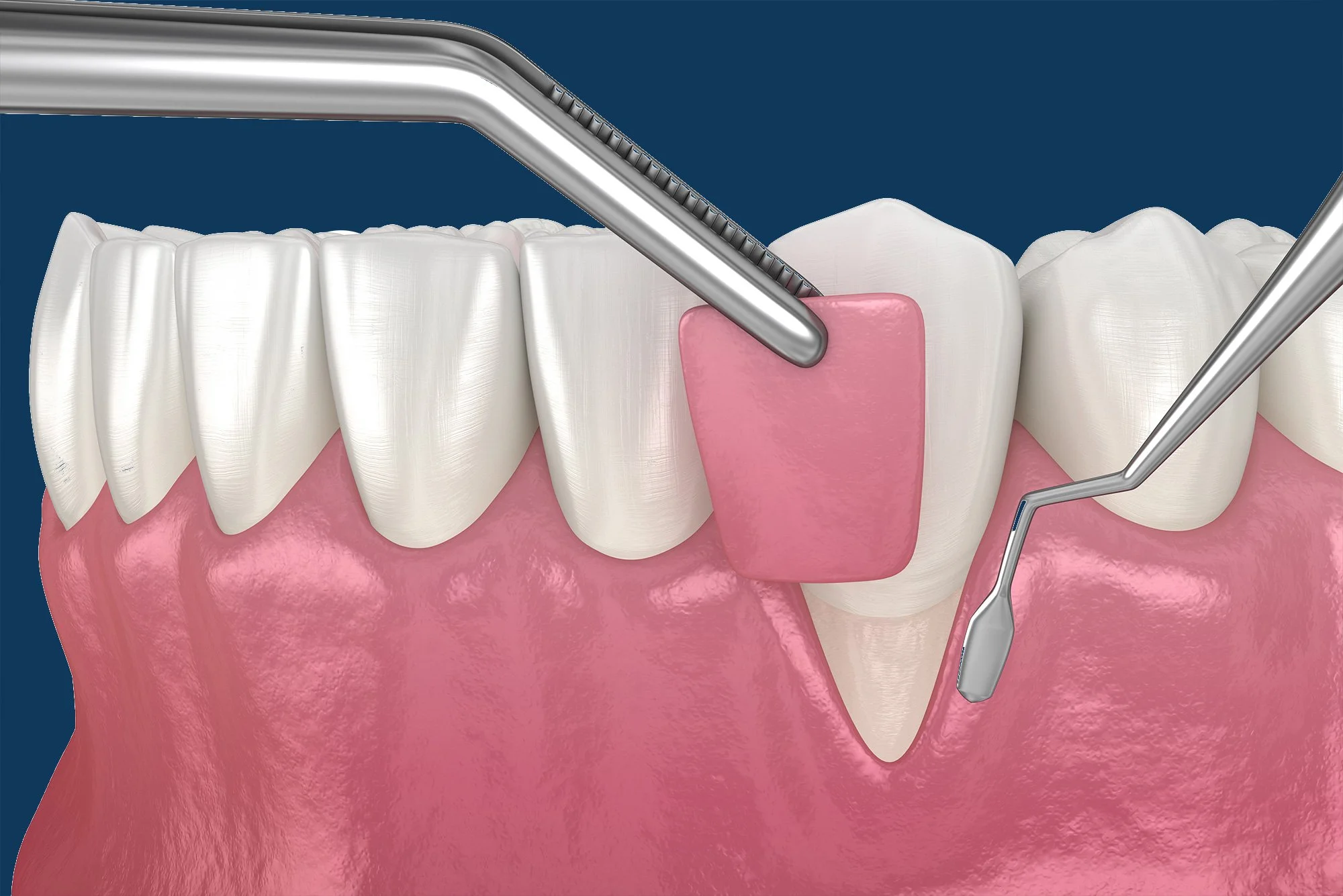 Reclaiming Your Smile: A Patient’s Guide to Gum Grafting