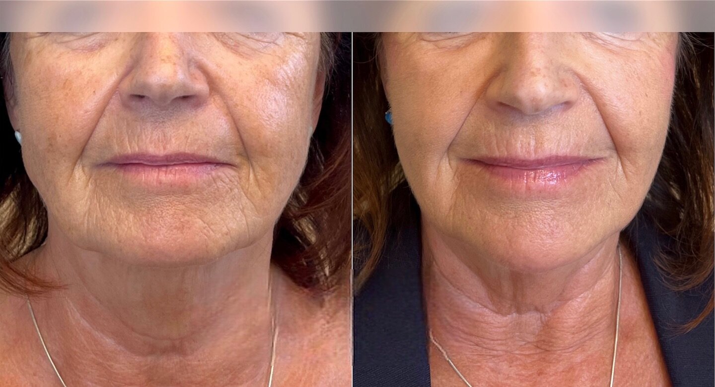 This is one of my favourite transformations and facial balancing. Pictures were taken 2 months apart after filler had time to settle and heal. 

This beautiful client of mine came to me wanting to look more refreshed and rejuvenated and we were so ha