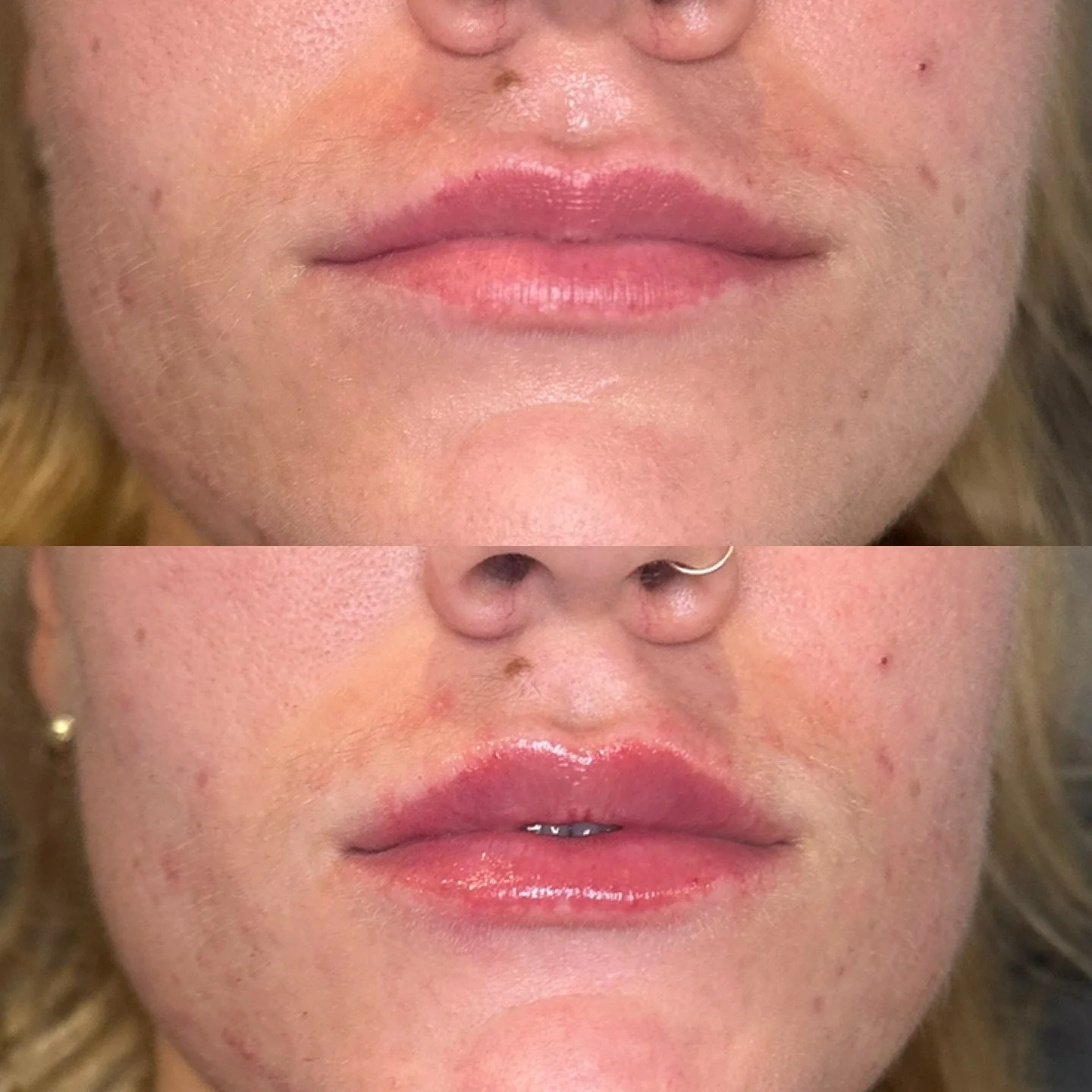 M-shape lips are one of the trickiest to treat because of the natural dip in the center. With careful technique, we were able soften and correct  the &lsquo;M&rsquo; shape while keeping natural shape of the lips 💋✨

📍Uptown Waterloo 
📧 info@skinri