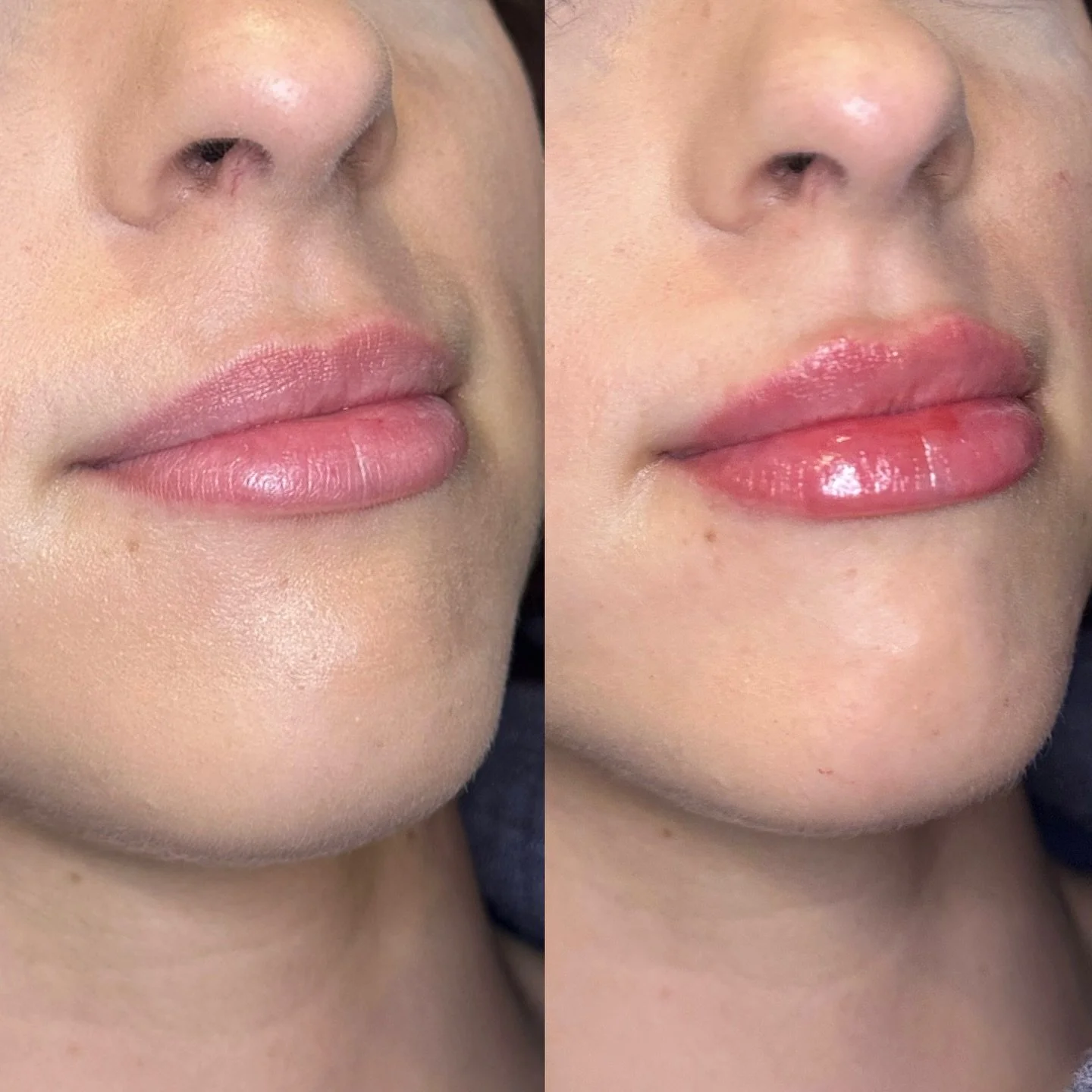 Summer refresh, but make it subtle ☀️💋 Slow and steady lip building keeps your shape naturally flawless. 

#lipfillerkw #naturallipfillerkw #revanesselips💋 #nurseinjectorkw #summergoals #liphydration #uofwstudents #wilfredlaurieruniversity