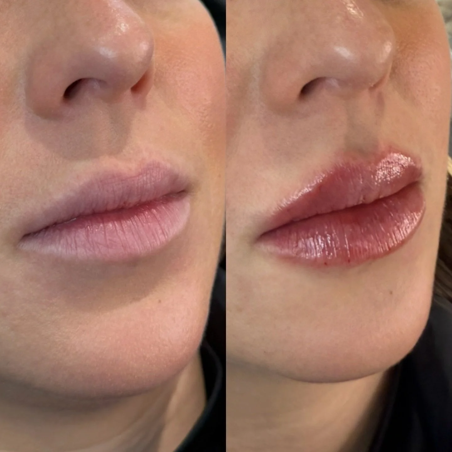💋 Signature Lip Enhancement 

Natural, defined, hydrated and beautifully balanced.

Why we love this approach:

✨ Soft, hydrated volume
✨ Enhanced borders + refined shape
✨ Smooth texture and symmetry
✨ Not overfilled

This gorgeous result was creat