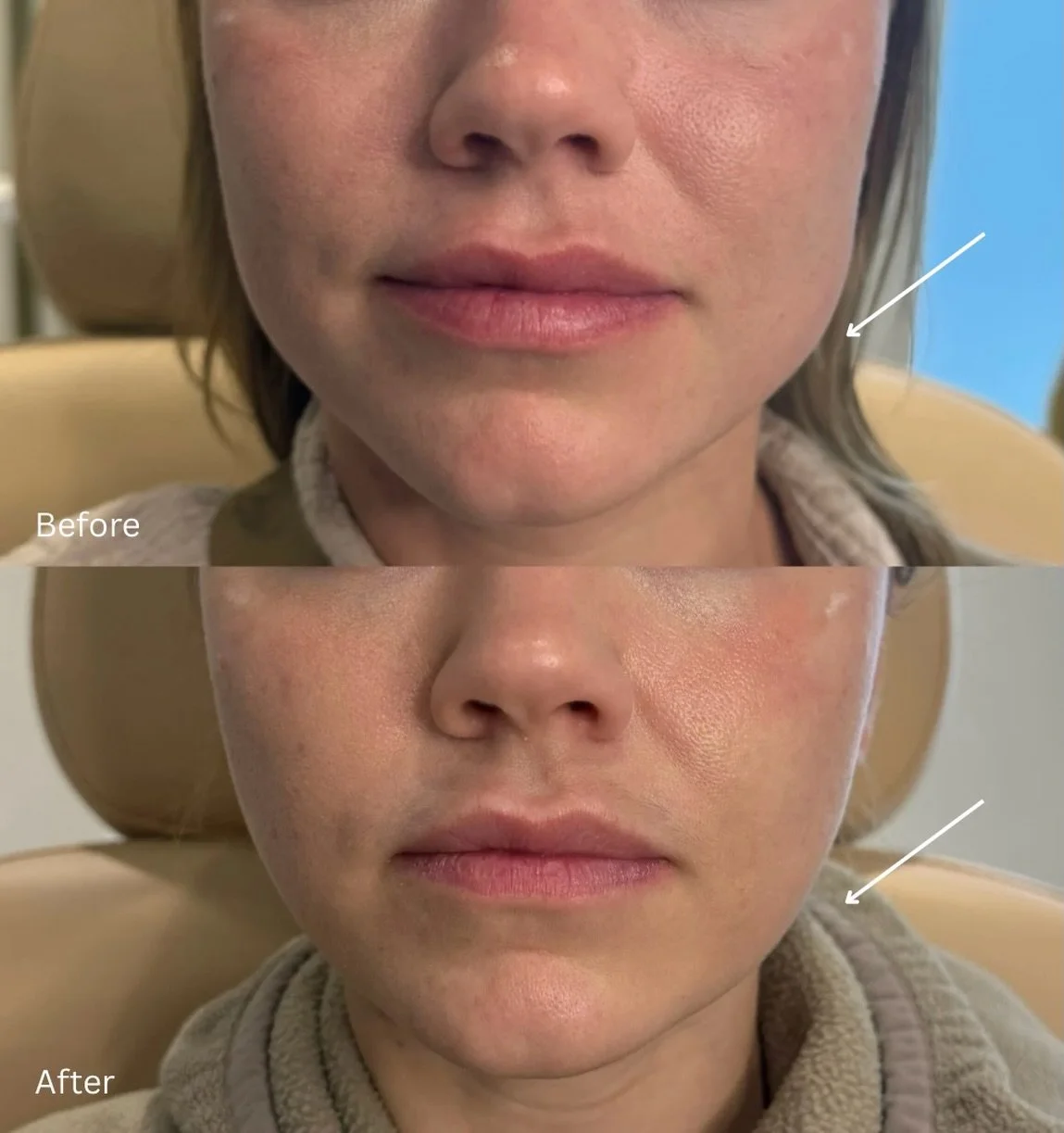 MASSETER BOTOX RESULTS 💫

By relaxing overactive jaw muscles, masseter Botox can:

&bull; Reduce jaw clenching and grinding
&bull; Slim the lower face
&bull;  Create a softer, more balanced V-shaped jawline

Results develop gradually over several we
