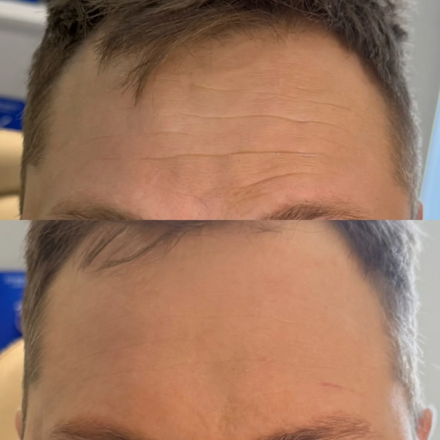 Botox is for everyone ! Yes, including the guys 💙

This client wanted to do something about his forehead lines and honestly? The results are everything. Natural, refreshed and completely him.
No frozen look, no downtime, just a little confidence boo