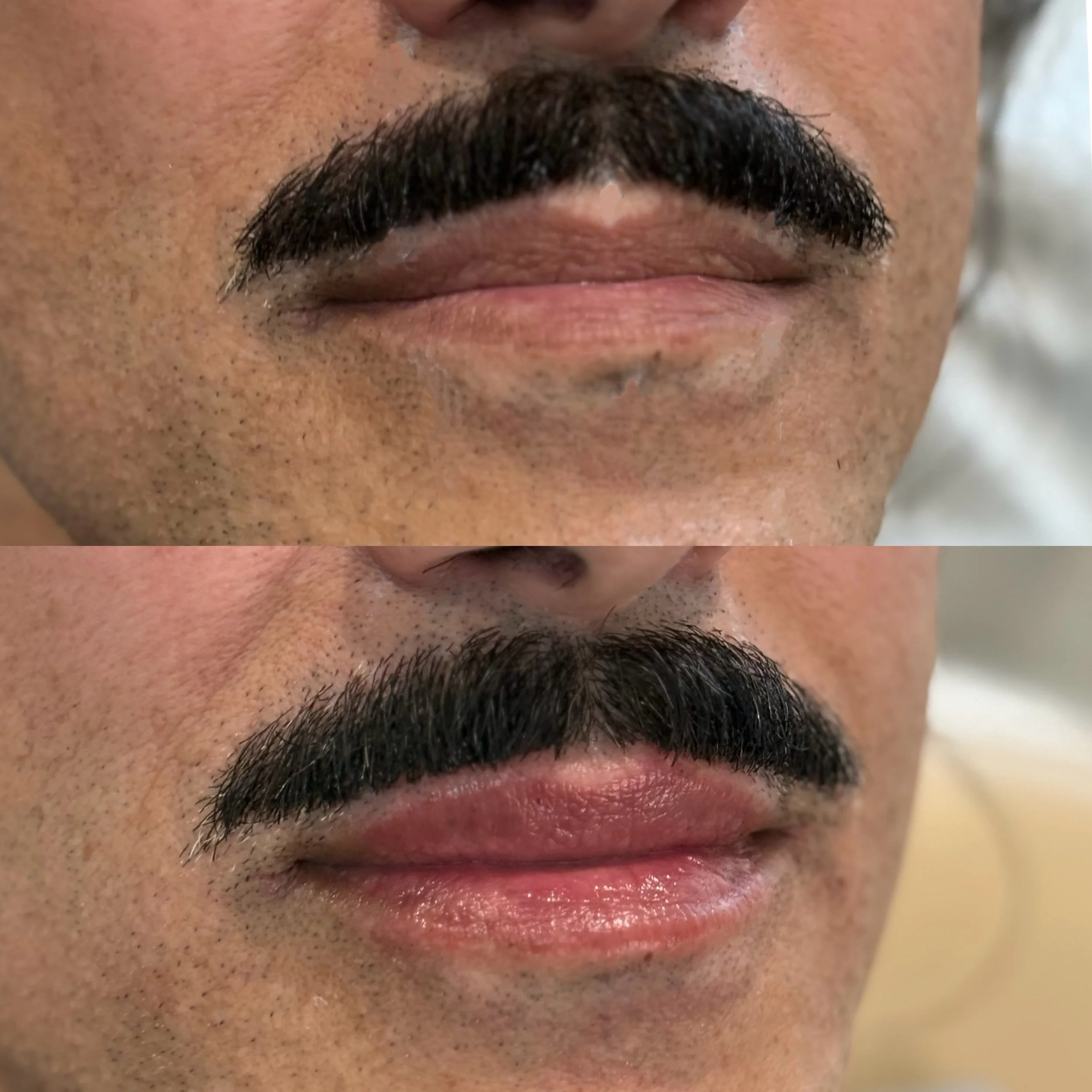 Lips from today. Fresh off the needle.

Every treatment starts with a conversation about goals and expectations. For this client, we focused on natural-looking volume, improved hydration, and a balanced result.