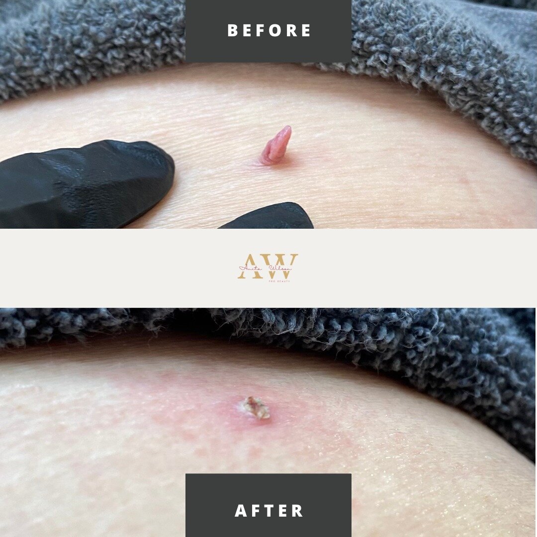 Advanced Epilation 

Anyone can develop skin tags at any stage in their life, Most of the time they are harmless and don&rsquo;t cause any pain or discomfort. However, depending on where they are located, you may find that they rub or snag on your cl