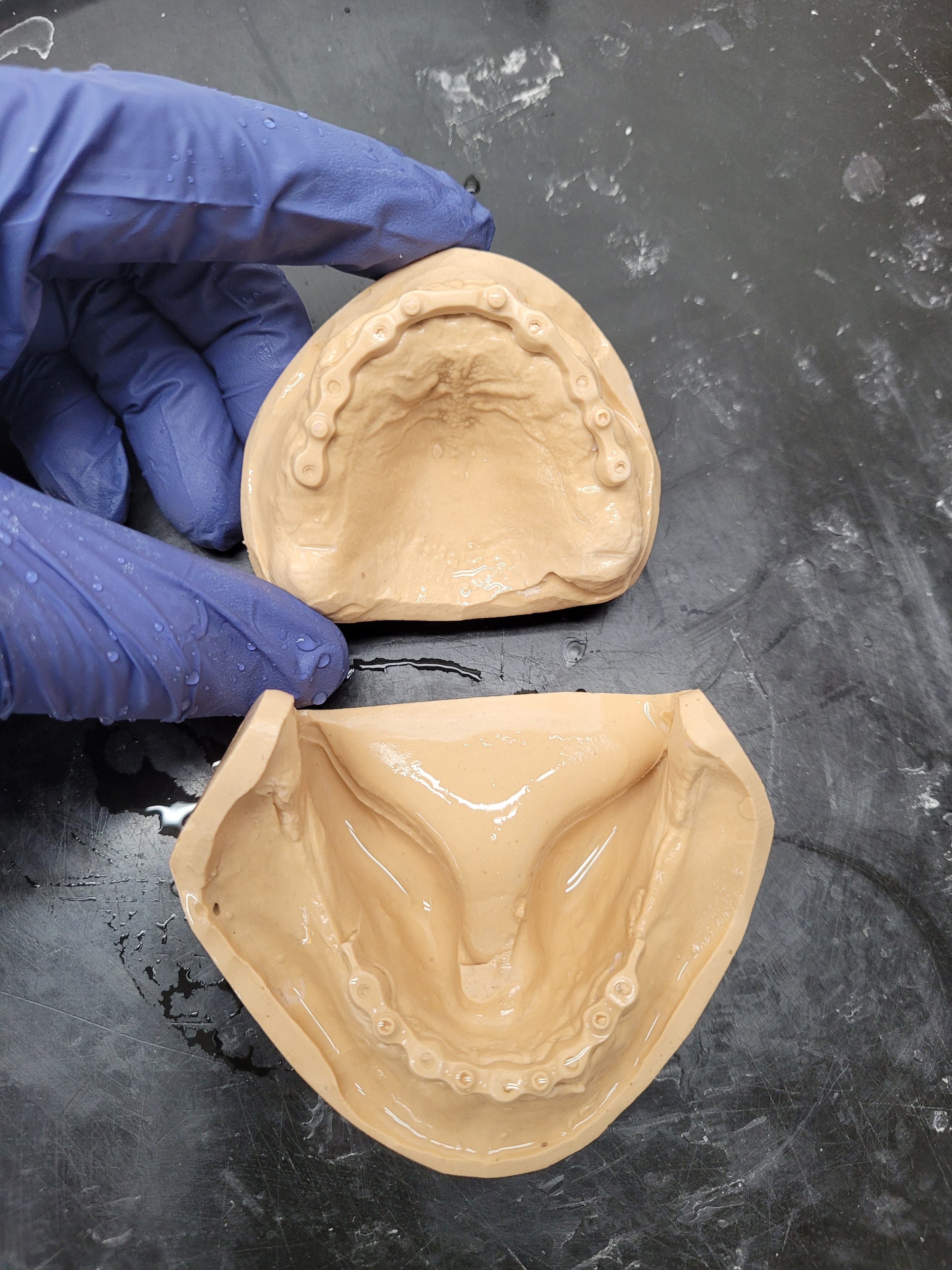 Implant denture 1.jpg