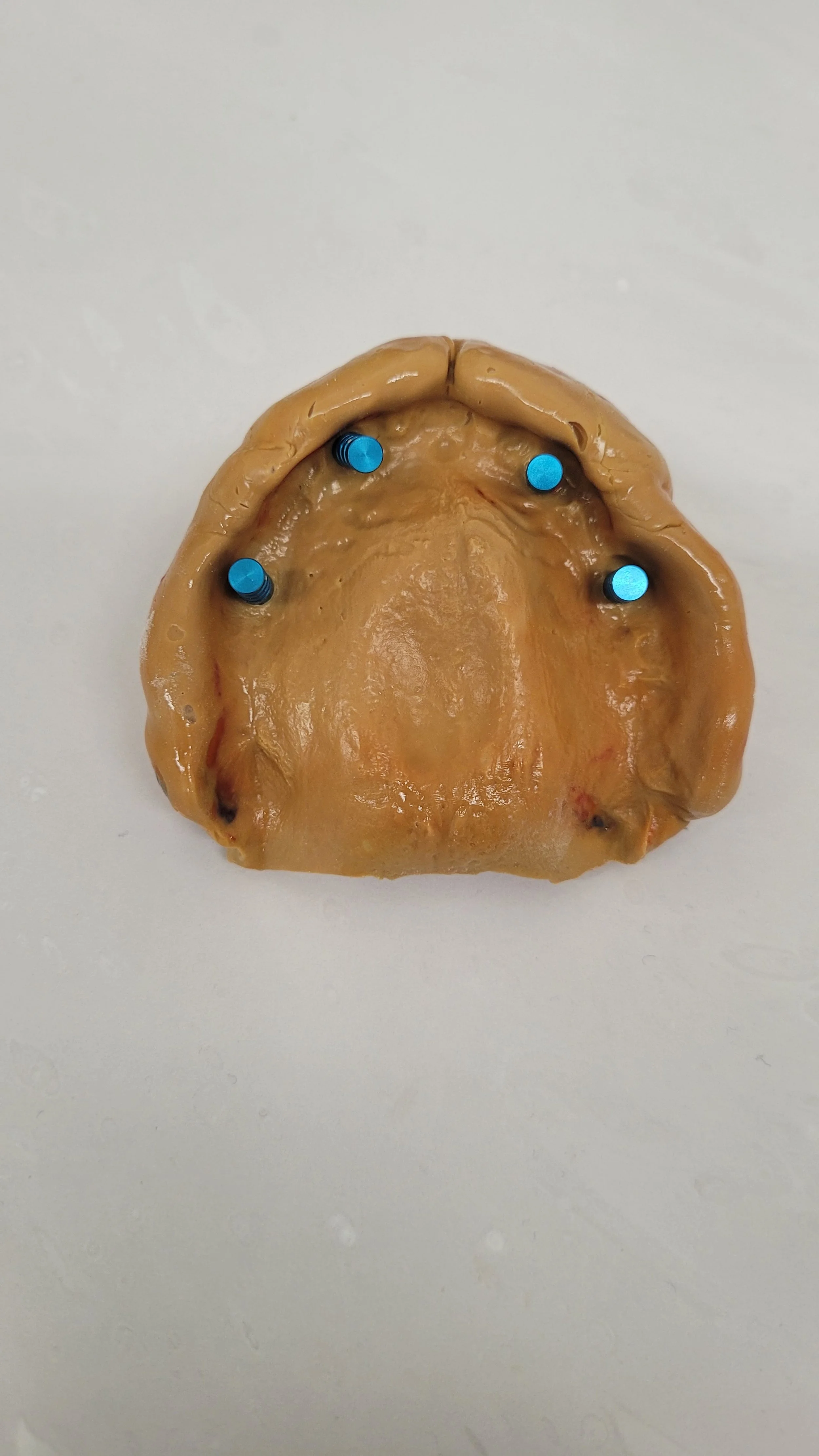 Implant Denture 9.jpg