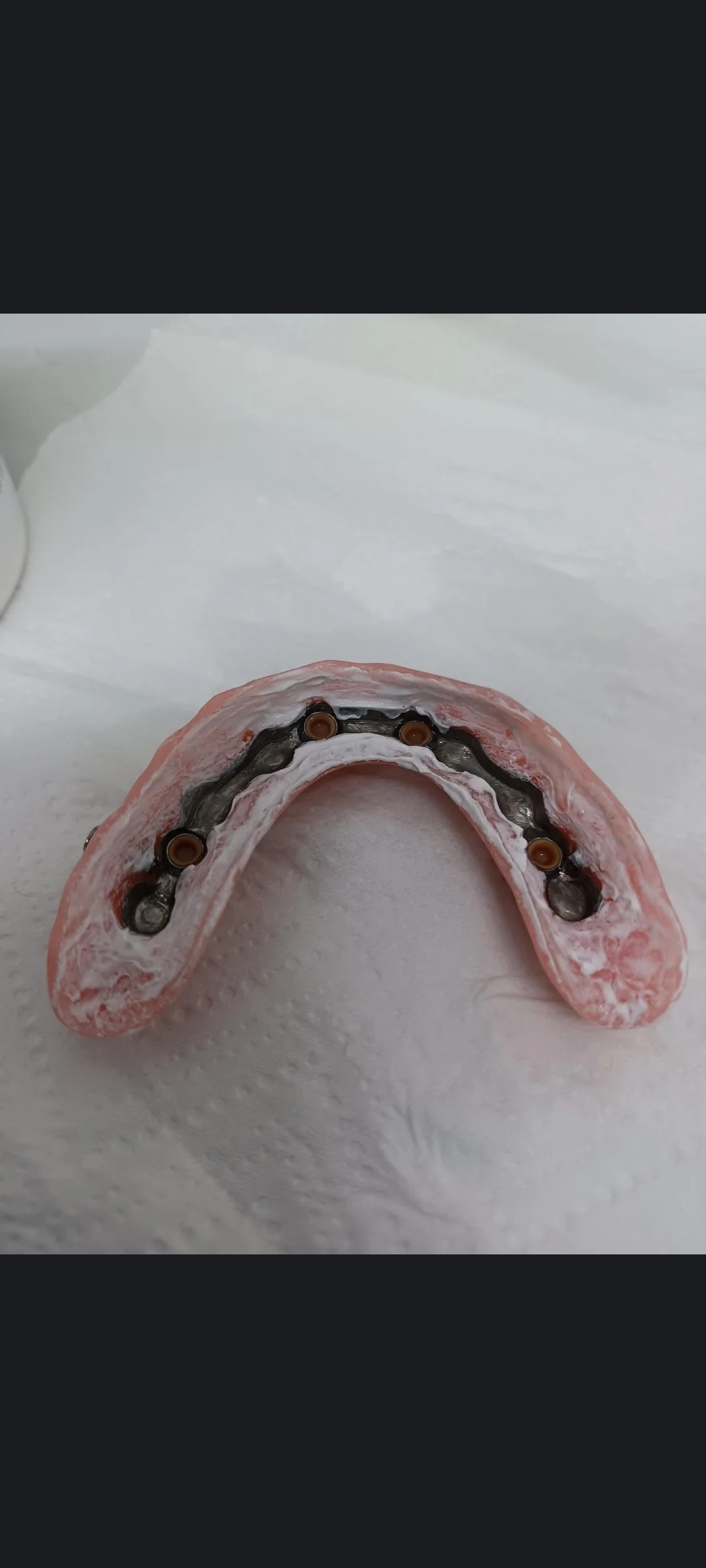 Implant Denture 2.jpg