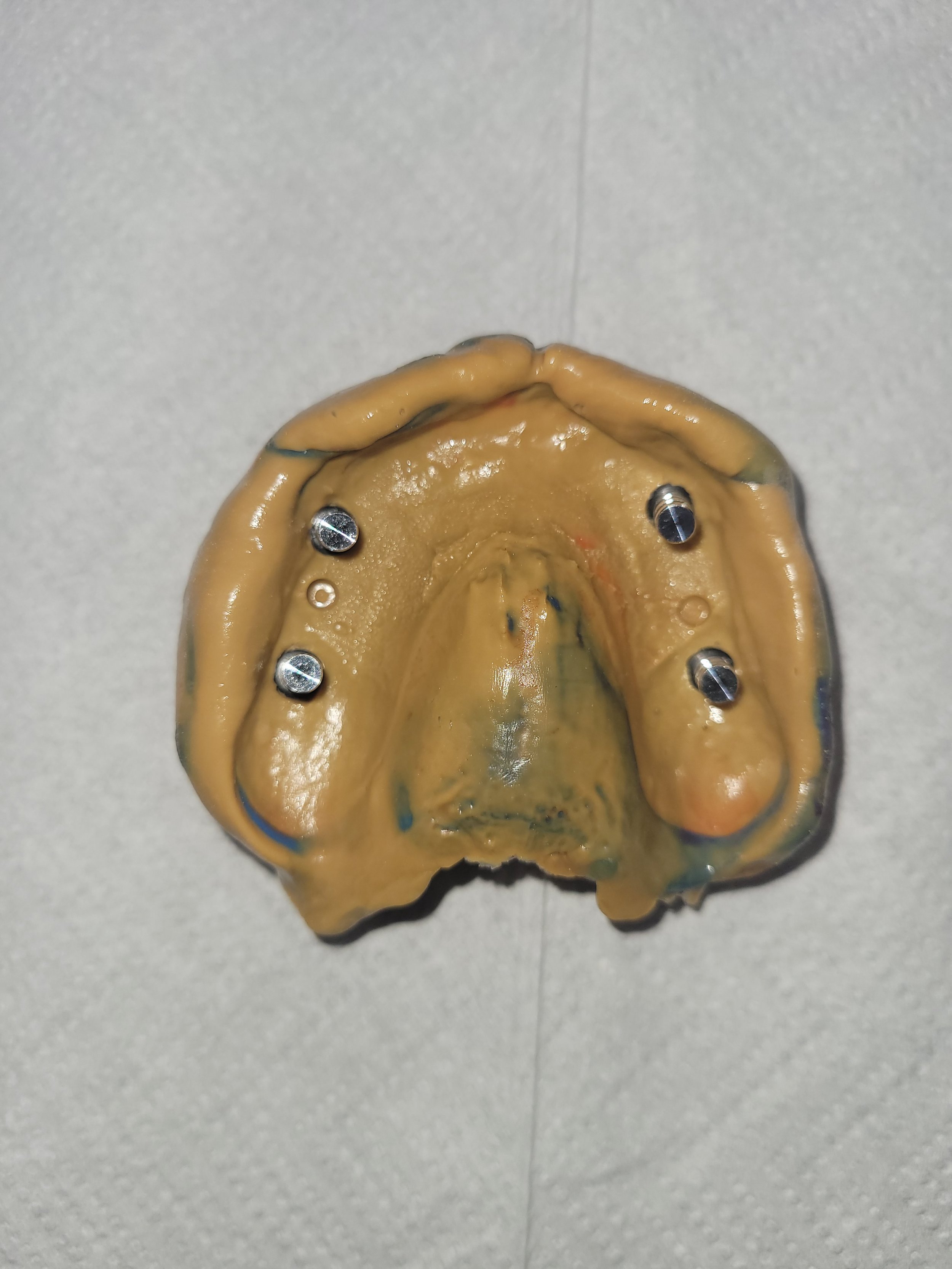 Implant Denture 4.jpg