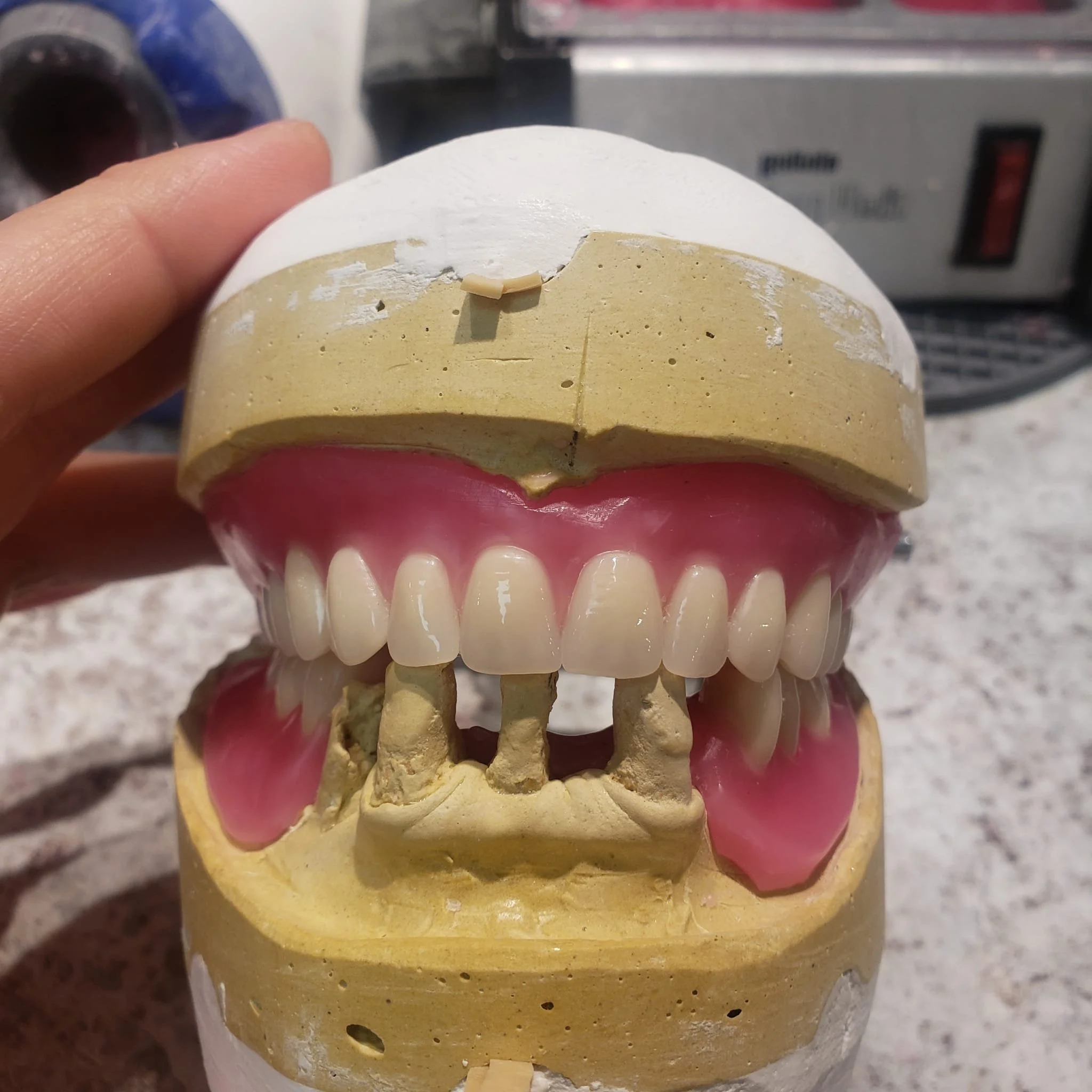 Complete Denture 7.jpg